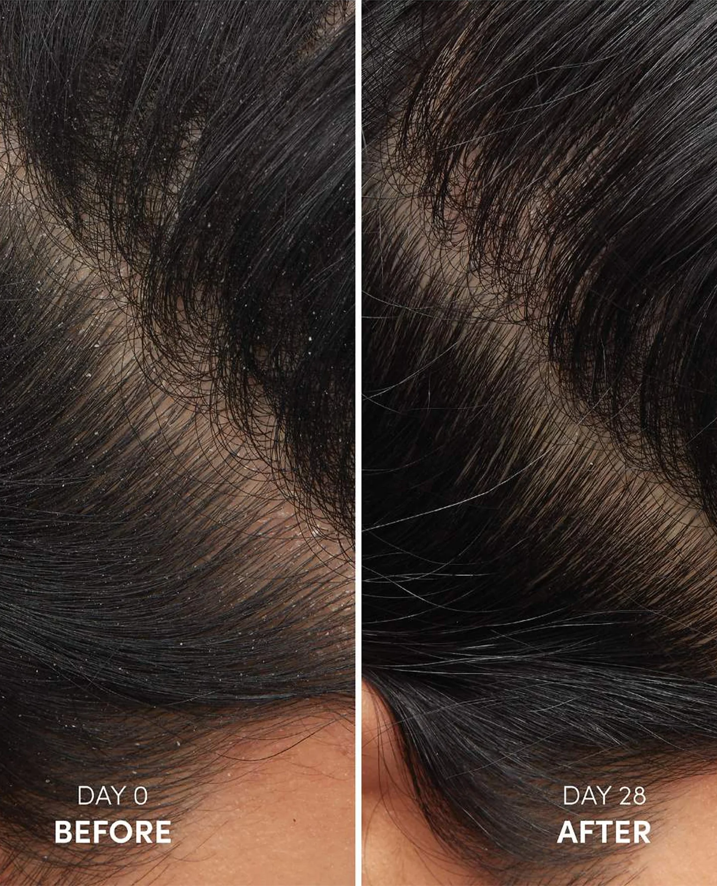 Anti-Dandruff Shampoo 8 Anti-Dandruff Shampoo